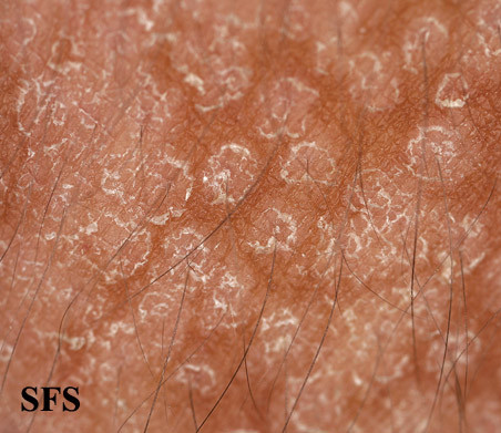 Tinea Versicolor (Neck, Chest, Back, Arm Skin Fungus 