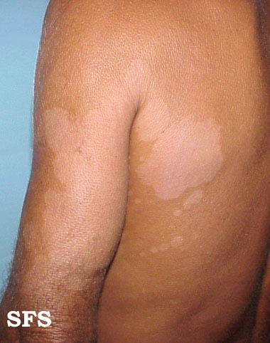 Tinea Versicolor (Neck, Chest, Back, Arm Skin Fungus) Pictures ...
