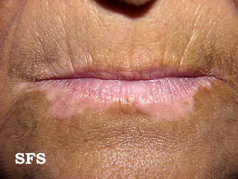 Vitiligo (White Patchy Skin Disease) Causes, Symptoms 